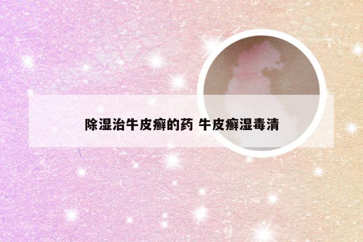 除湿治牛皮癣的药 牛皮癣湿毒清