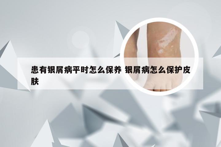患有银屑病平时怎么保养 银屑病怎么保护皮肤