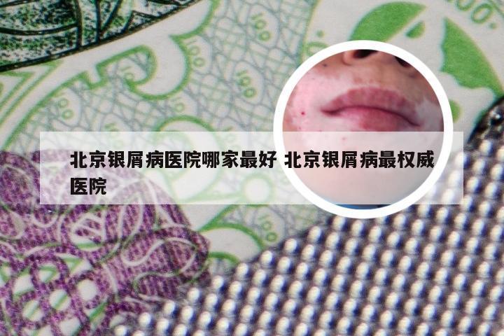 北京银屑病医院哪家最好 北京银屑病最权威医院