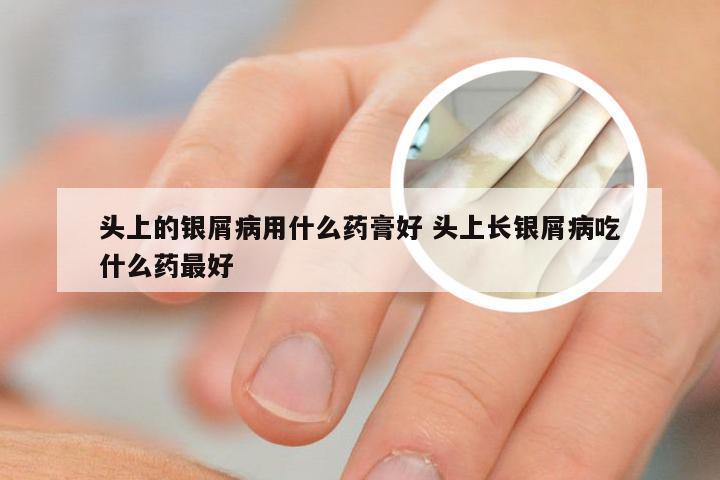 头上的银屑病用什么药膏好 头上长银屑病吃什么药最好