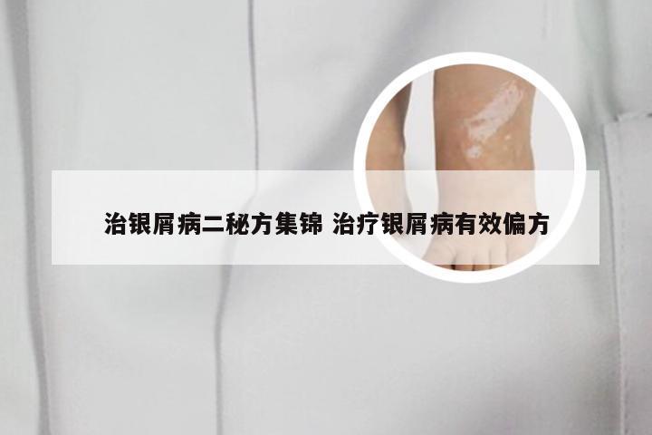 治银屑病二秘方集锦 治疗银屑病有效偏方
