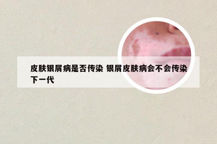 皮肤银屑病是否传染 银屑皮肤病会不会传染下一代