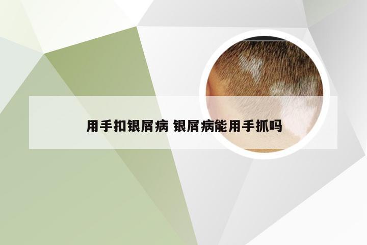 用手扣银屑病 银屑病能用手抓吗