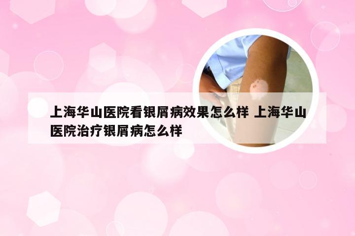 上海华山医院看银屑病效果怎么样 上海华山医院治疗银屑病怎么样