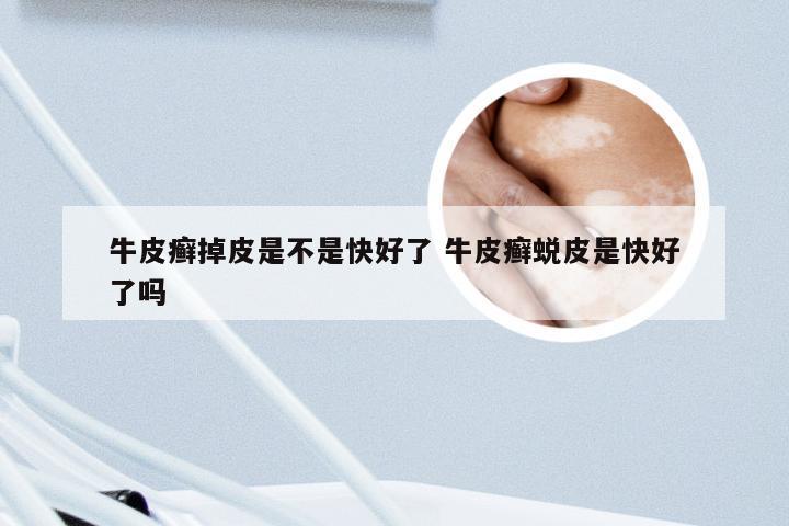 牛皮癣掉皮是不是快好了 牛皮癣蜕皮是快好了吗