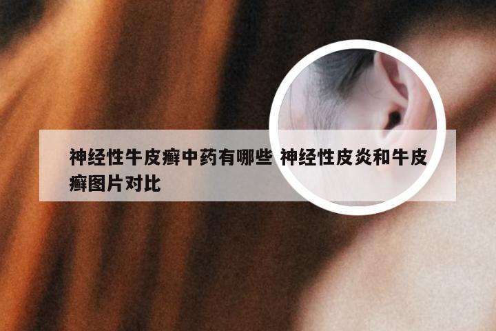 神经性牛皮癣中药有哪些 神经性皮炎和牛皮癣图片对比