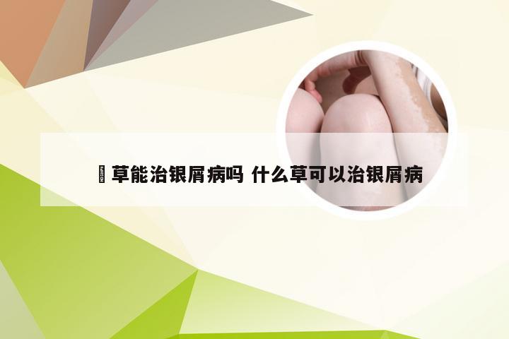 葎草能治银屑病吗 什么草可以治银屑病