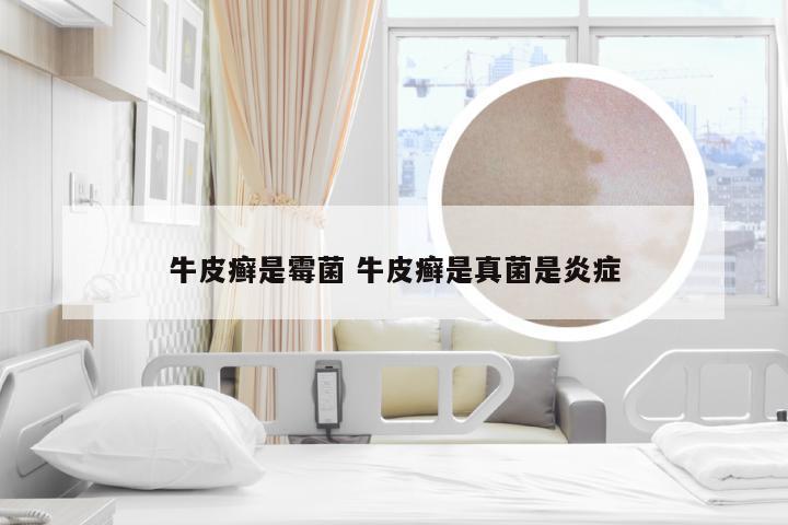 牛皮癣是霉菌 牛皮癣是真菌是炎症