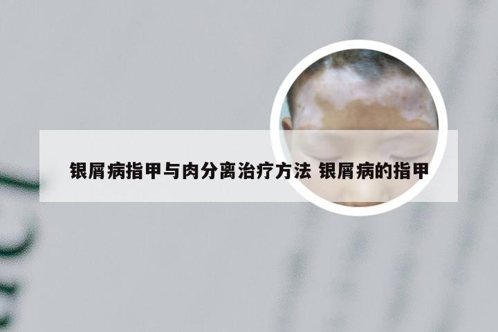 银屑病指甲与肉分离治疗方法 银屑病的指甲