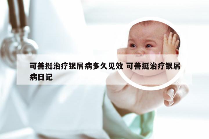 可善挺治疗银屑病多久见效 可善挺治疗银屑病日记