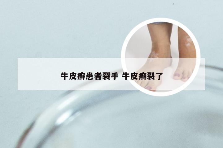 牛皮癣患者裂手 牛皮癣裂了
