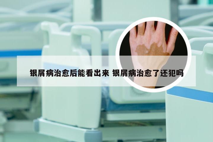 银屑病治愈后能看出来 银屑病治愈了还犯吗
