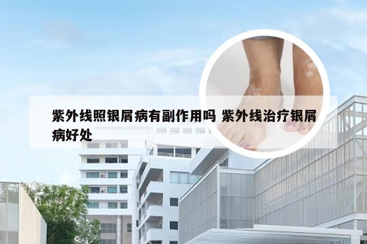 紫外线照银屑病有副作用吗 紫外线治疗银屑病好处