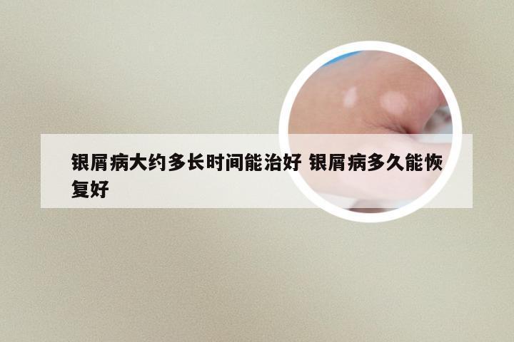 银屑病大约多长时间能治好 银屑病多久能恢复好