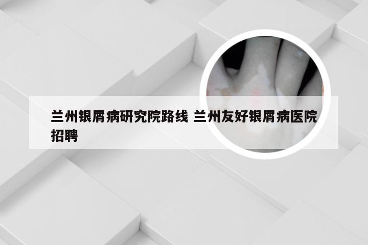 兰州银屑病研究院路线 兰州友好银屑病医院招聘