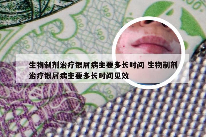 生物制剂治疗银屑病主要多长时间 生物制剂治疗银屑病主要多长时间见效