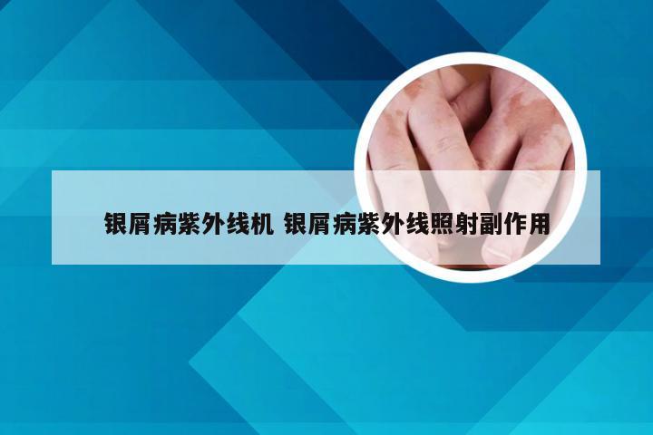 银屑病紫外线机 银屑病紫外线照射副作用