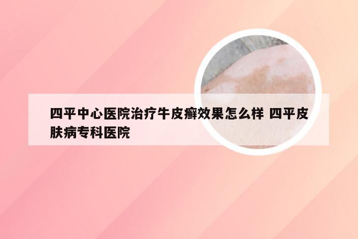 四平中心医院治疗牛皮癣效果怎么样 四平皮肤病专科医院