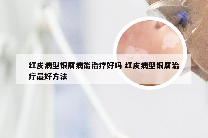 红皮病型银屑病能治疗好吗 红皮病型银屑治疗最好方法