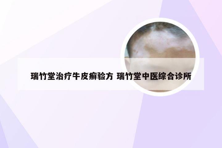 瑞竹堂治疗牛皮癣验方 瑞竹堂中医综合诊所