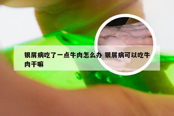 银屑病吃了一点牛肉怎么办 银屑病可以吃牛肉干嘛