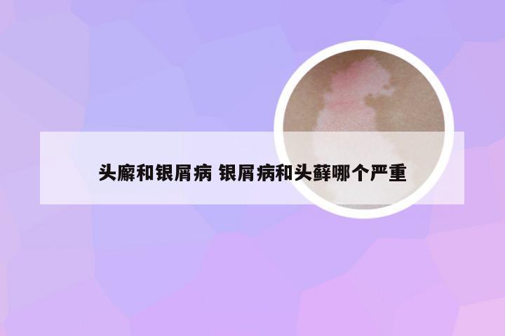 头廨和银屑病 银屑病和头藓哪个严重