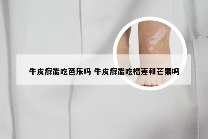 牛皮癣能吃芭乐吗 牛皮癣能吃榴莲和芒果吗