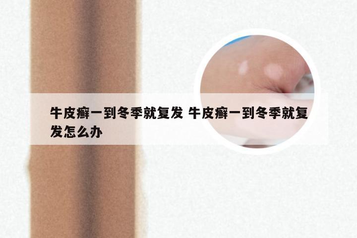 牛皮癣一到冬季就复发 牛皮癣一到冬季就复发怎么办