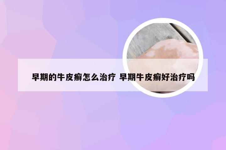 早期的牛皮癣怎么治疗 早期牛皮癣好治疗吗