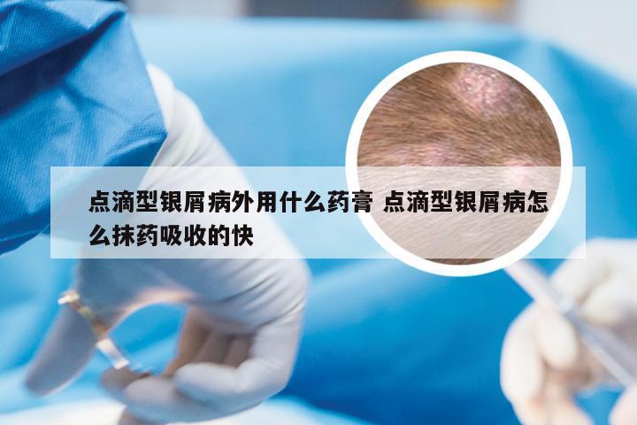 点滴型银屑病外用什么药膏 点滴型银屑病怎么抹药吸收的快