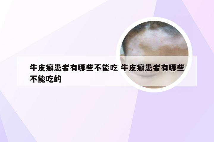 牛皮癣患者有哪些不能吃 牛皮癣患者有哪些不能吃的