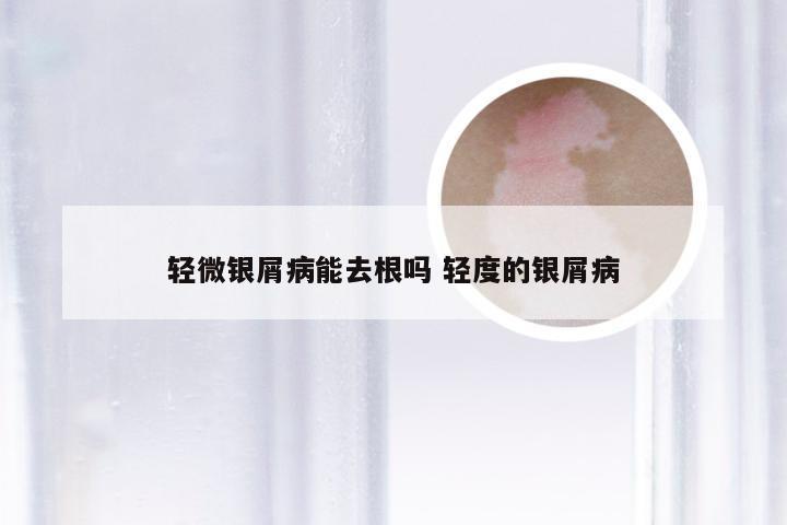 轻微银屑病能去根吗 轻度的银屑病
