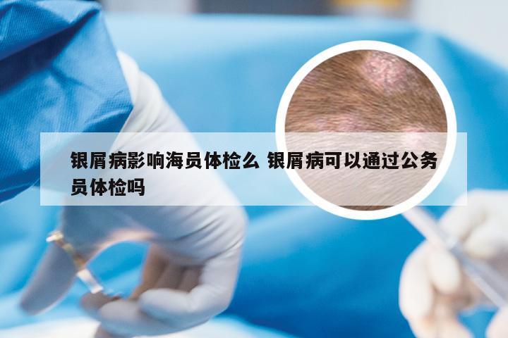 银屑病影响海员体检么 银屑病可以通过公务员体检吗