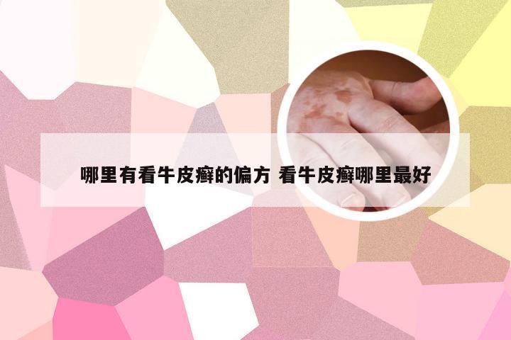 哪里有看牛皮癣的偏方 看牛皮癣哪里最好