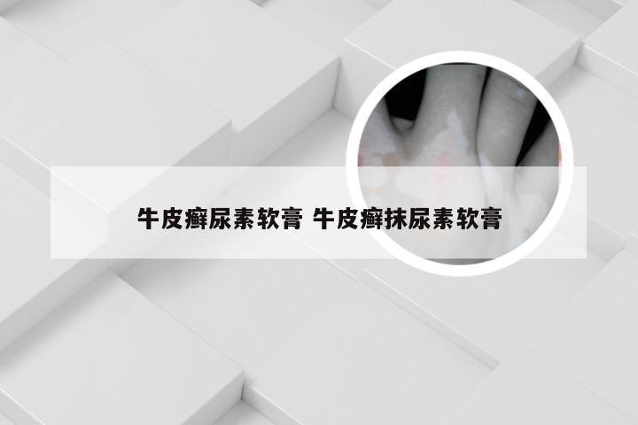 牛皮癣尿素软膏 牛皮癣抹尿素软膏