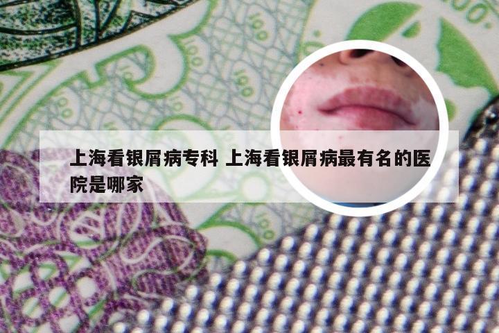 上海看银屑病专科 上海看银屑病最有名的医院是哪家
