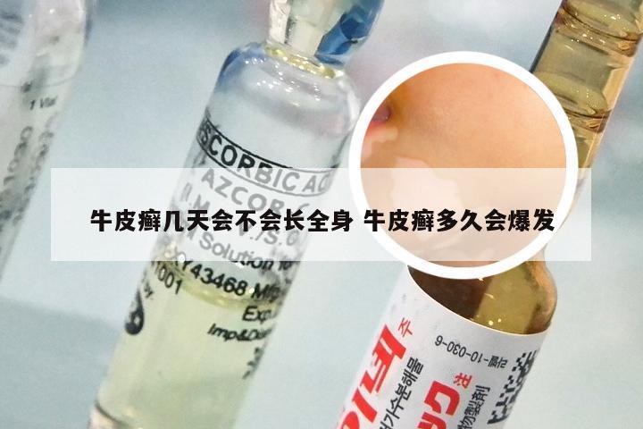 牛皮癣几天会不会长全身 牛皮癣多久会爆发