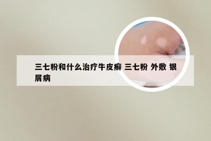 三七粉和什么治疗牛皮癣 三七粉 外敷 银屑病