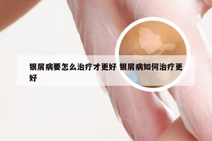 银屑病要怎么治疗才更好 银屑病如何治疗更好