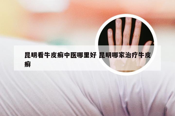 昆明看牛皮癣中医哪里好 昆明哪家治疗牛皮癣