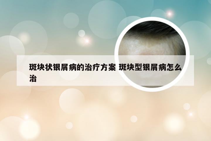 斑块状银屑病的治疗方案 斑块型银屑病怎么治