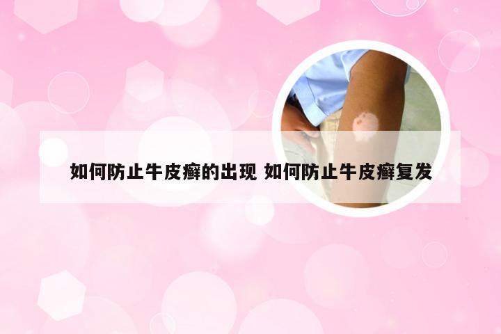 如何防止牛皮癣的出现 如何防止牛皮癣复发