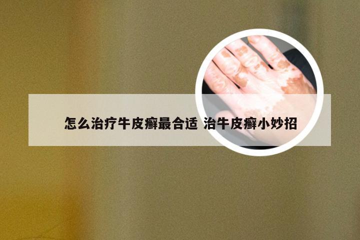 怎么治疗牛皮癣最合适 治牛皮癣小妙招