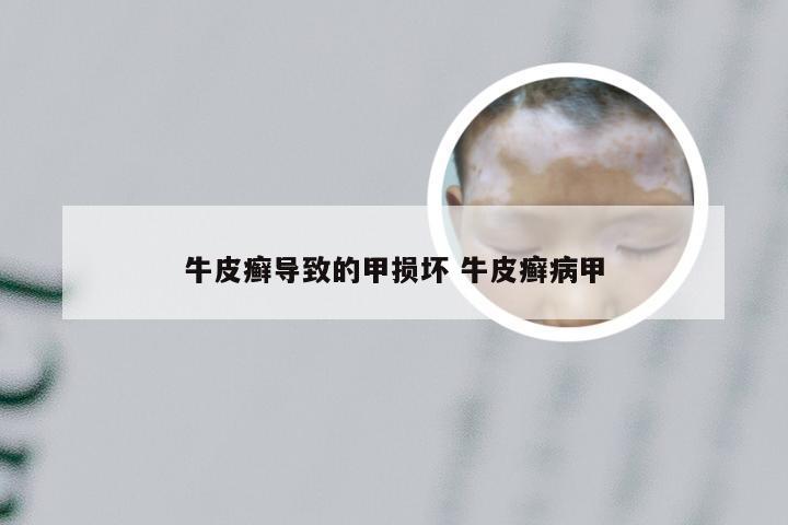 牛皮癣导致的甲损坏 牛皮癣病甲