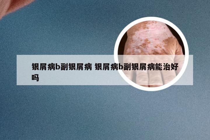 银屑病b副银屑病 银屑病b副银屑病能治好吗