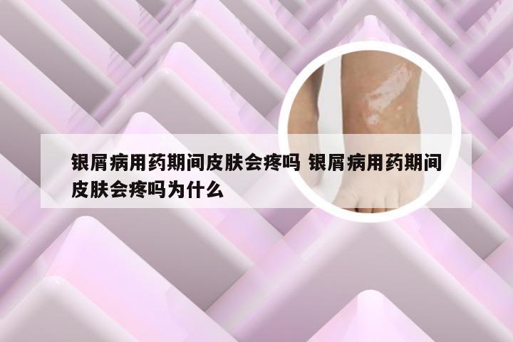 银屑病用药期间皮肤会疼吗 银屑病用药期间皮肤会疼吗为什么