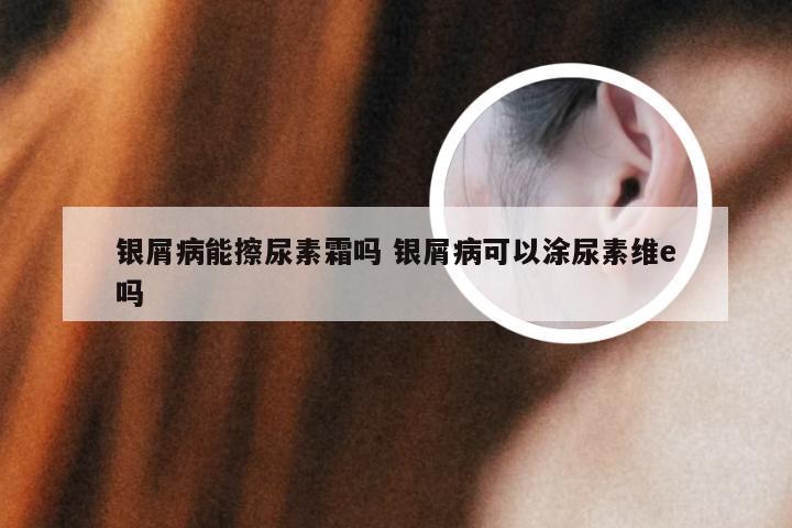 银屑病能擦尿素霜吗 银屑病可以涂尿素维e吗