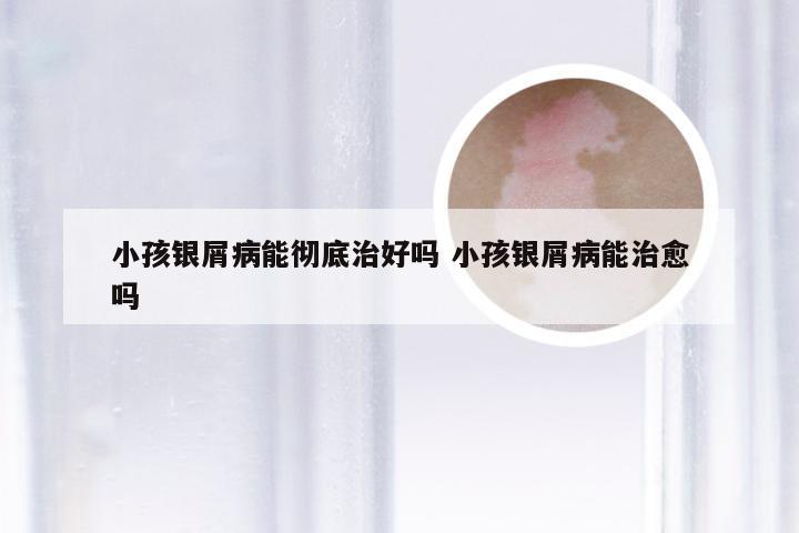 小孩银屑病能彻底治好吗 小孩银屑病能治愈吗