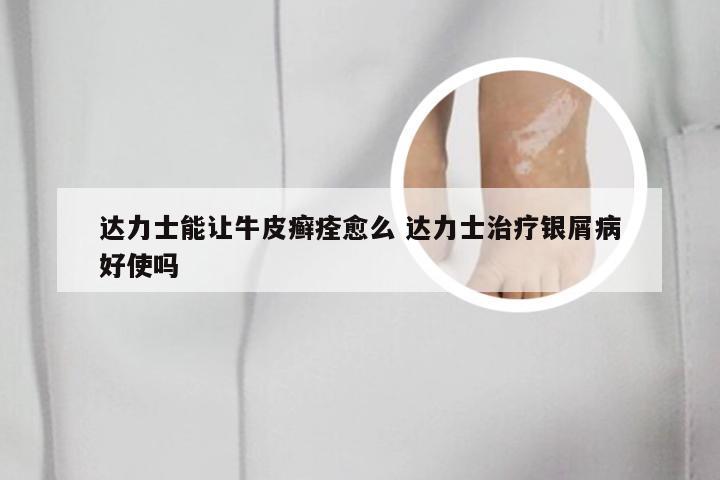 达力士能让牛皮癣痊愈么 达力士治疗银屑病好使吗