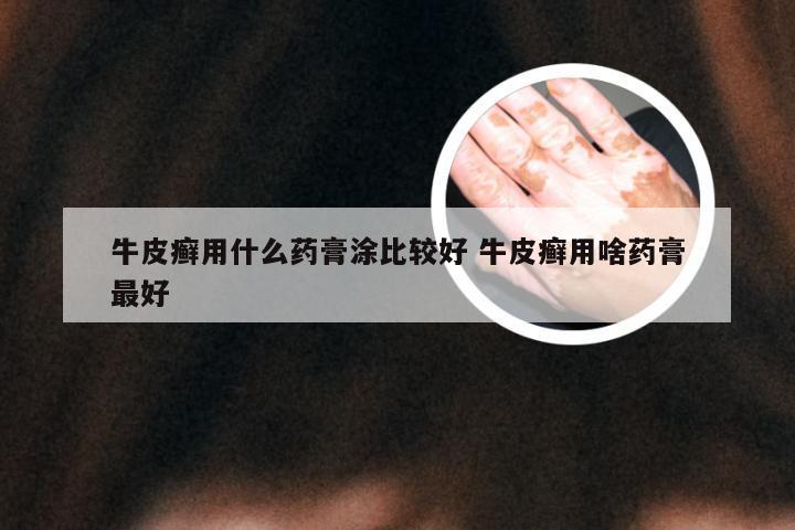 牛皮癣用什么药膏涂比较好 牛皮癣用啥药膏最好